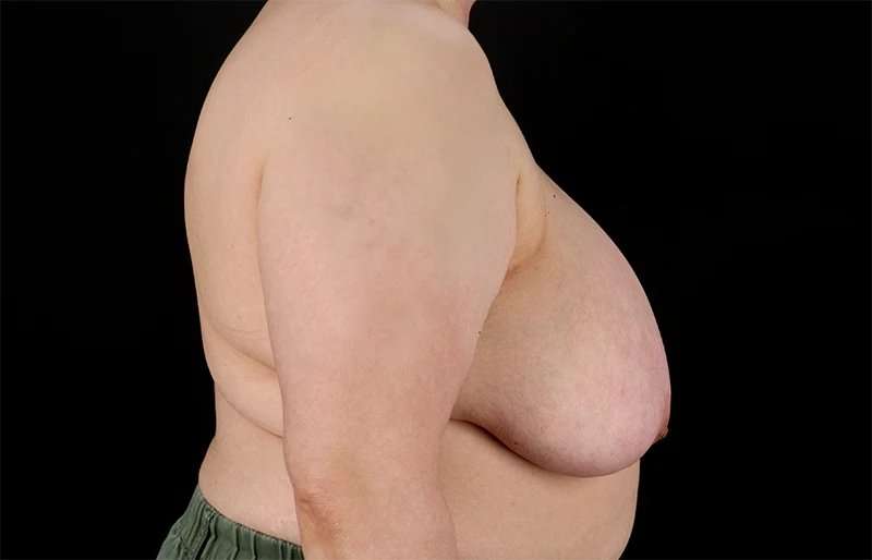 FTM Chest Contouring Before & After Patient #2050