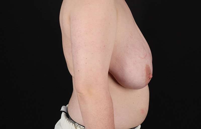 FTM Chest Contouring Before & After Patient #2083