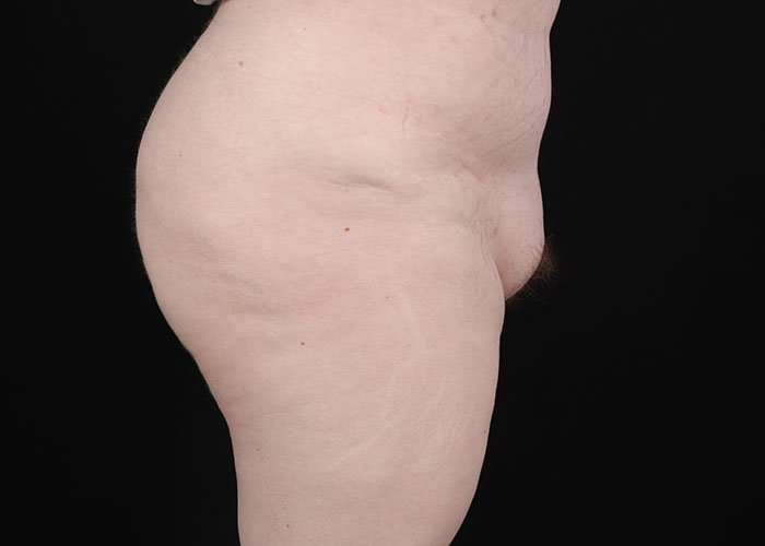 Monsplasty Before & After Patient #2106