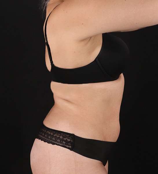 Tummy Tuck Before & After Patient #2128