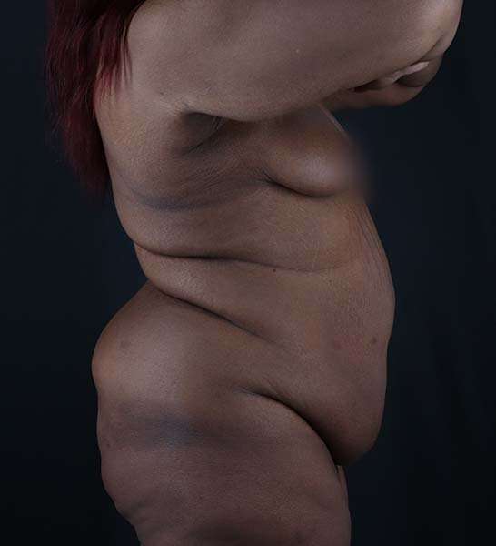 Tummy Tuck Before & After Patient #2139