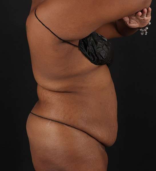 Tummy Tuck Before & After Patient #2146
