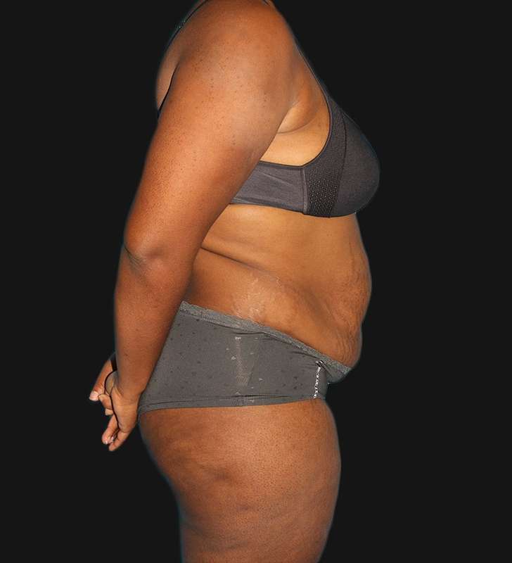 Tummy Tuck Before & After Patient #2179