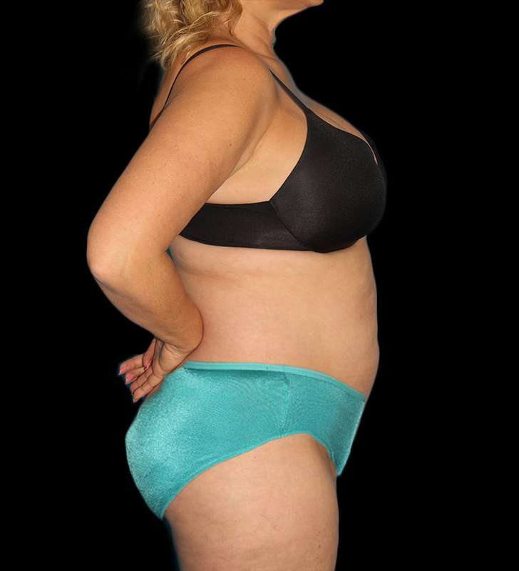 Tummy Tuck Before & After Patient #2190