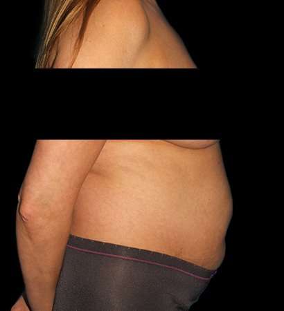 Tummy Tuck Before & After Patient #2201