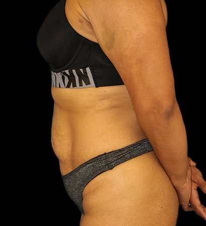 Tummy Tuck Before & After Patient #2212