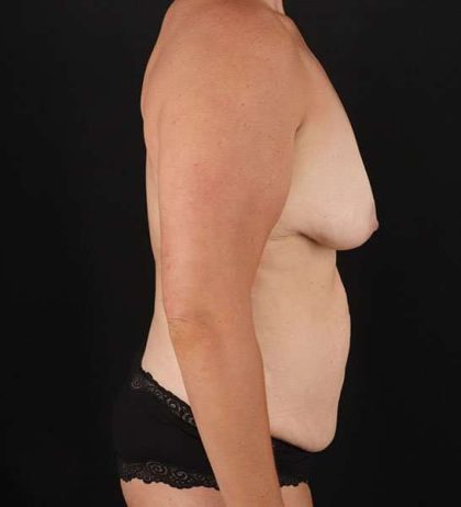 Tummy Tuck Before & After Patient #2247