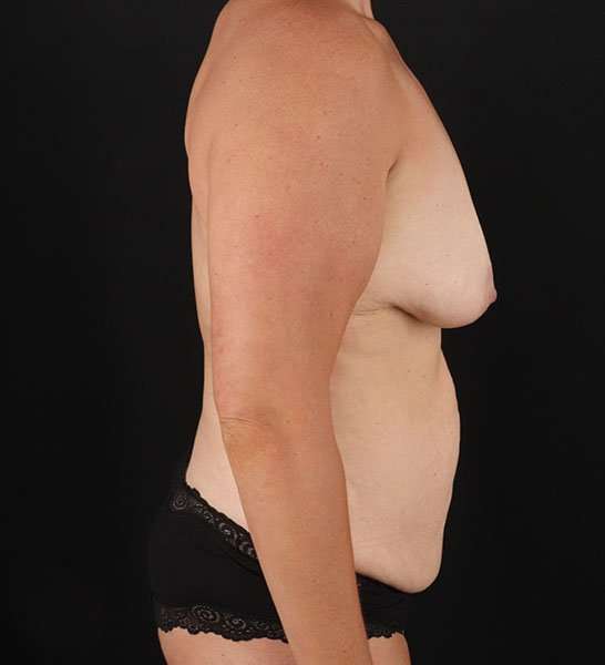 Tummy Tuck Before & After Patient #2247