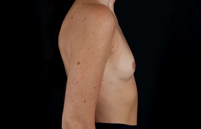 Breast Augmentation - Implant Before & After Patient #1012