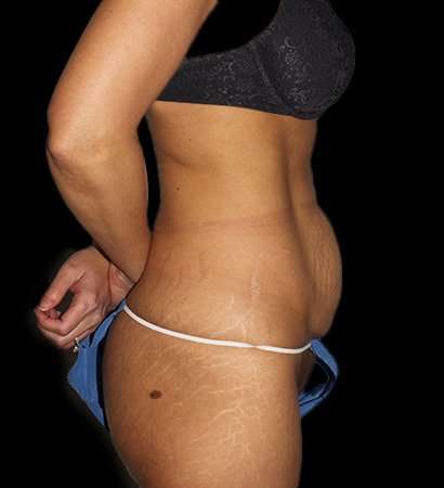 Tummy Tuck Before & After Patient #2269