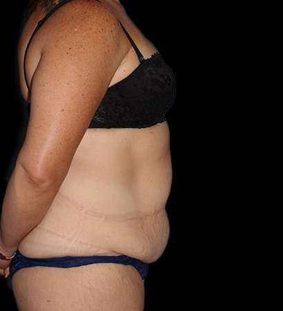 Tummy Tuck Before & After Patient #2280