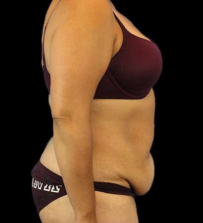 Tummy Tuck Before & After Patient #2291