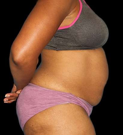 Tummy Tuck Before & After Patient #2302