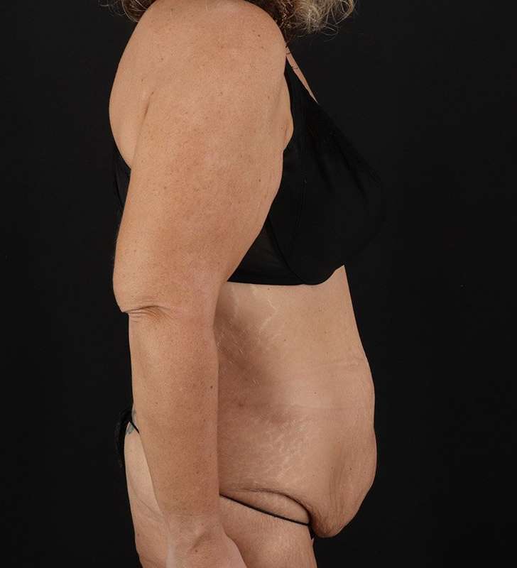 Tummy Tuck Before & After Patient #2326
