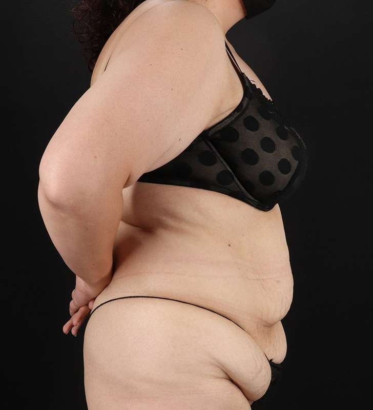 Tummy Tuck Before & After Patient #2339