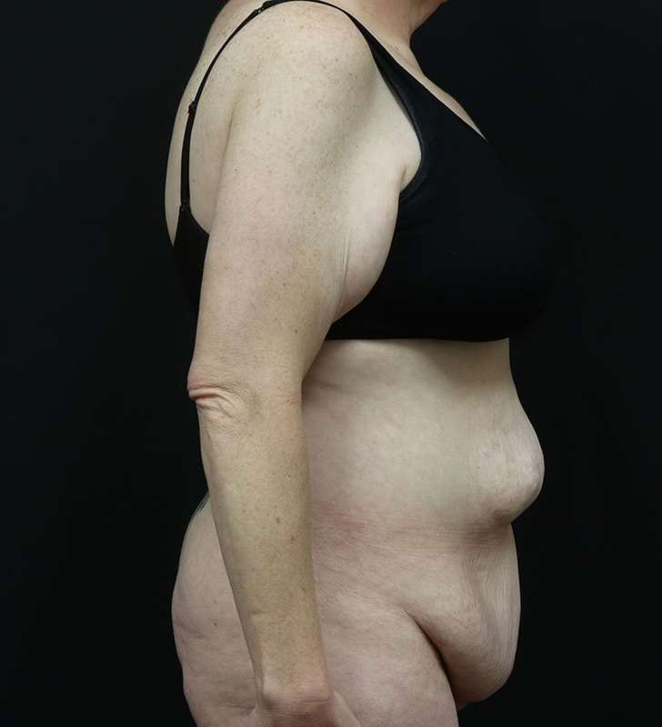 Tummy Tuck Before & After Patient #2363