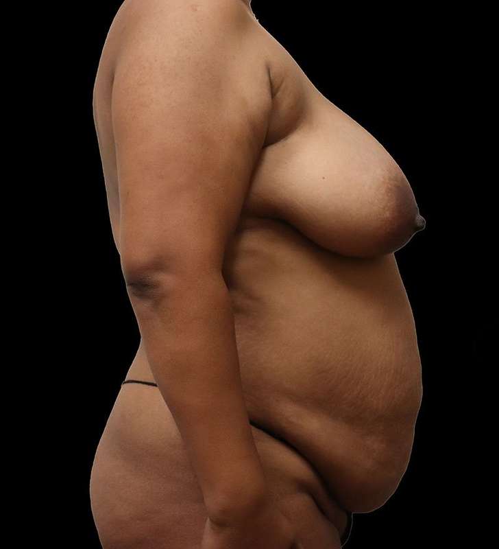 Tummy Tuck Before & After Patient #2389