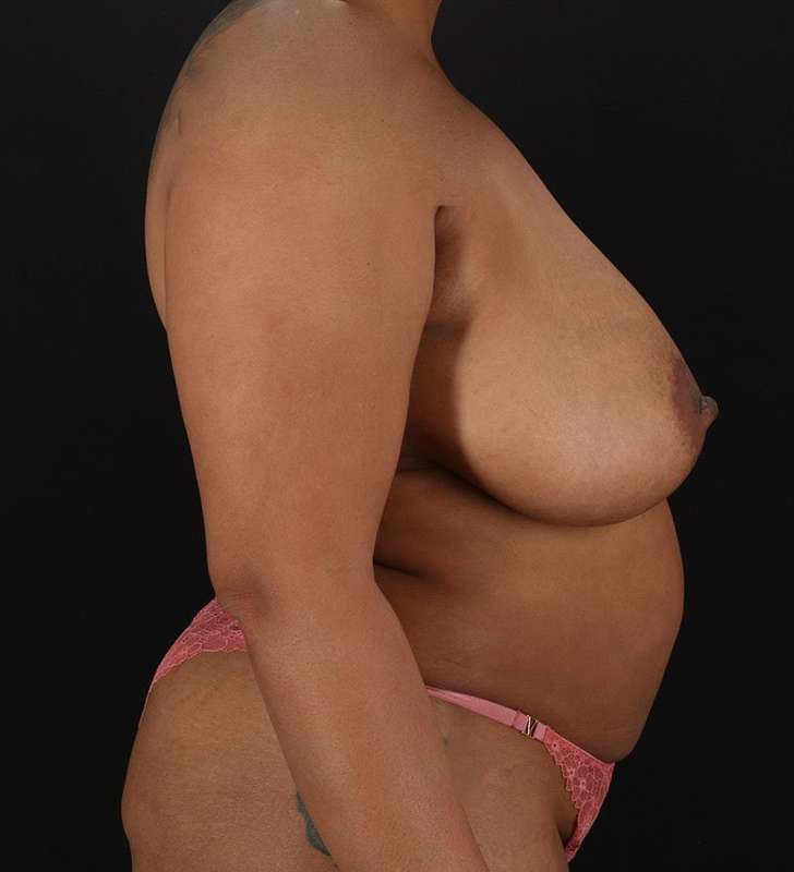Tummy Tuck Before & After Patient #2402