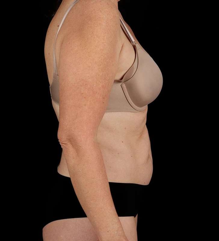 Tummy Tuck Before & After Patient #2435