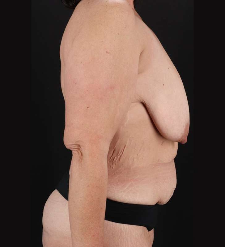 Tummy Tuck Before & After Patient #2461