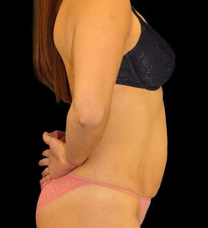 Tummy Tuck Before & After Patient #2485