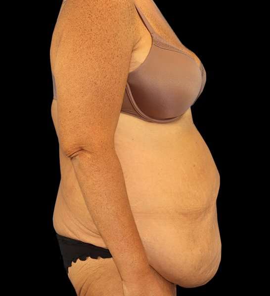 Circumferential Body Lift Before & After Patient #2509