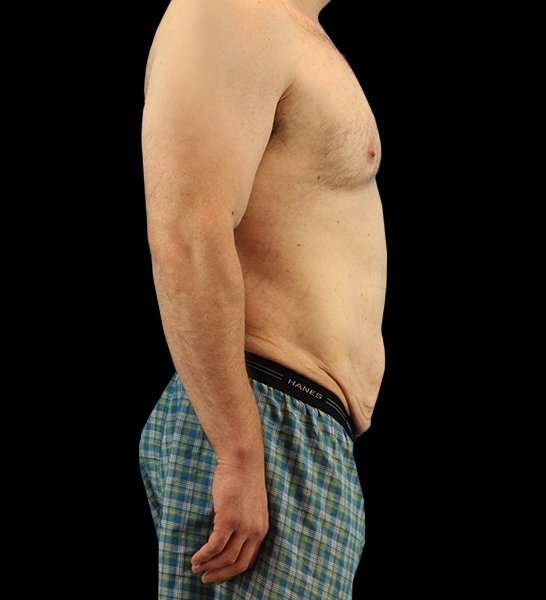 Circumferential Body Lift Before & After Patient #2522