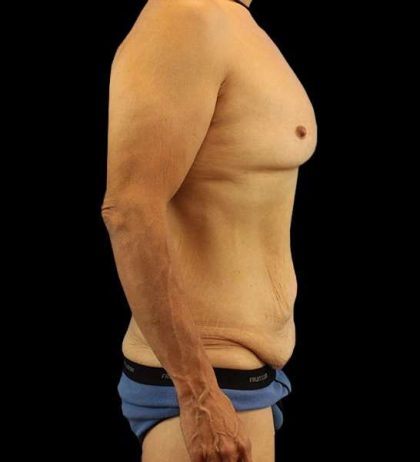 Circumferential Body Lift Before & After Patient #2535