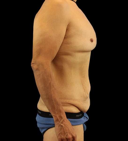 Circumferential Body Lift Before & After Patient #2535