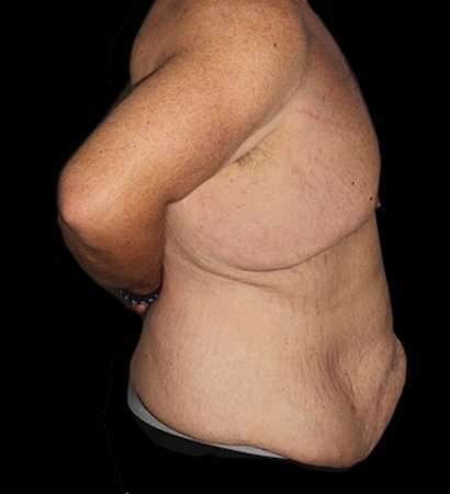 Massive Weight Loss Before & After Patient #5155