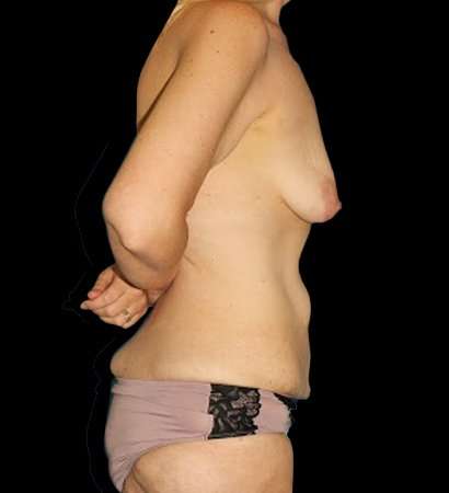 Circumferential Body Lift Before & After Patient #2559