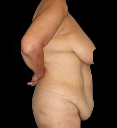 Circumferential Body Lift Before & After Patient #2572