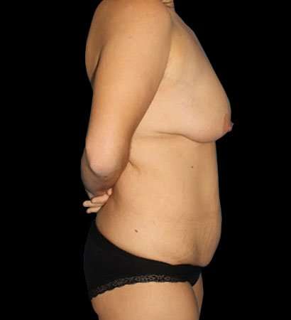 Circumferential Body Lift Before & After Patient #2585