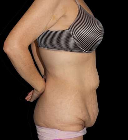 Circumferential Body Lift Before & After Patient #2598