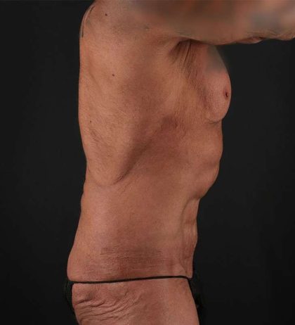 Circumferential Body Lift Before & After Patient #2611