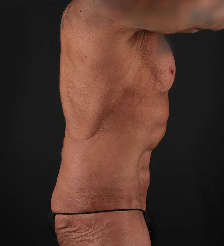 Circumferential Body Lift Before & After Patient #2611