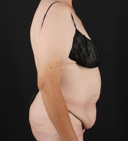 Circumferential Body Lift Before & After Patient #2624
