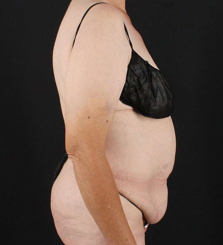 Circumferential Body Lift Before & After Patient #2624