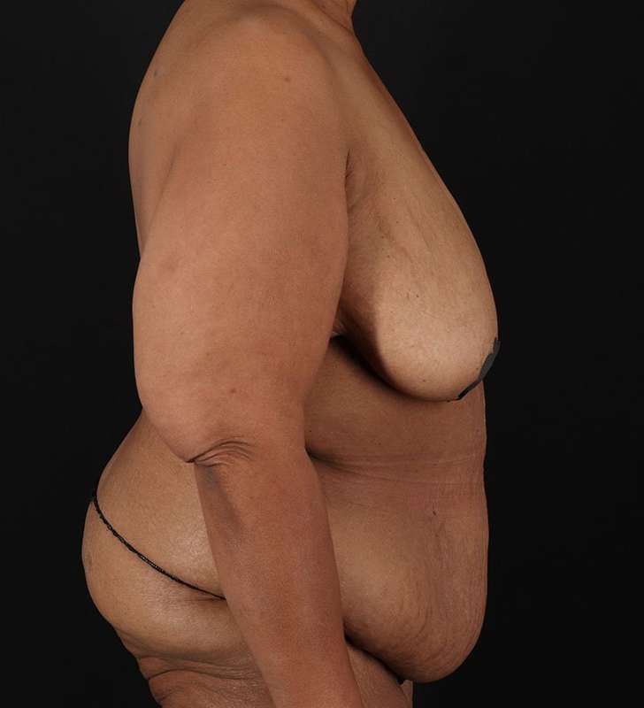 Circumferential Body Lift Before & After Patient #2637