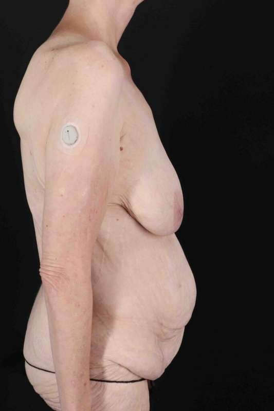 Circumferential Body Lift Before & After Patient #2663