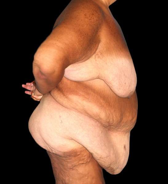 Fleur De Lis Circumferential Body Lift Before & After Patient #2674