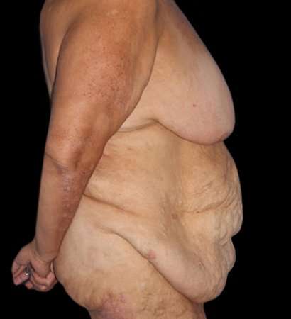 Fleur De Lis Circumferential Body Lift Before & After Patient #2685