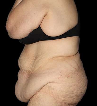 Fleur De Lis Tummy Tuck Before & After Patient #2692