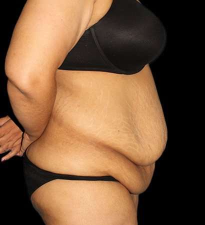 Fleur De Lis Tummy Tuck Before & After Patient #2703