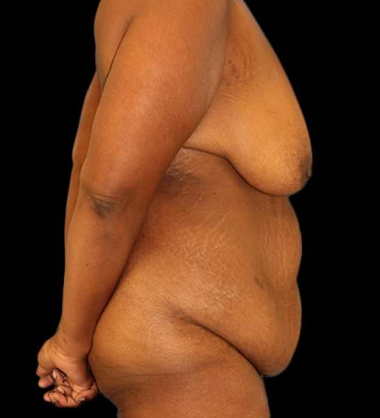 Fleur De Lis Tummy Tuck Before & After Patient #2714