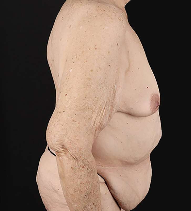 Fleur De Lis Tummy Tuck Before & After Patient #2727