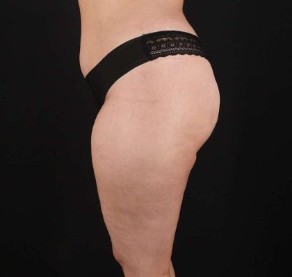 Liposuction Before & After Patient #2736