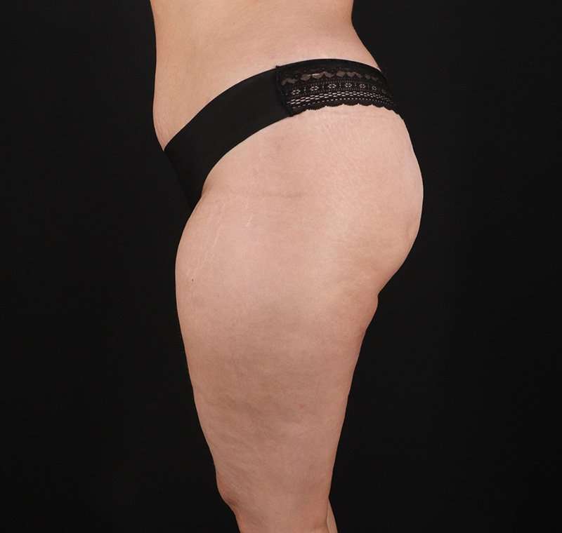 Liposuction Before & After Patient #2736