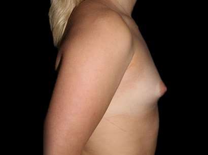 Breast Augmentation - Implant Before & After Patient #1050