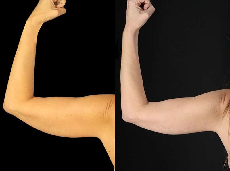 Liposuction Before & After Patient #2743